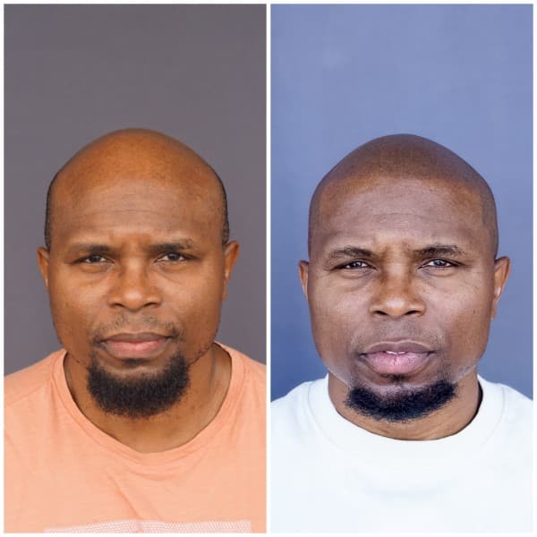 Alopecia SMP treatment before and after result 1 at Union Barber SMP Torrance