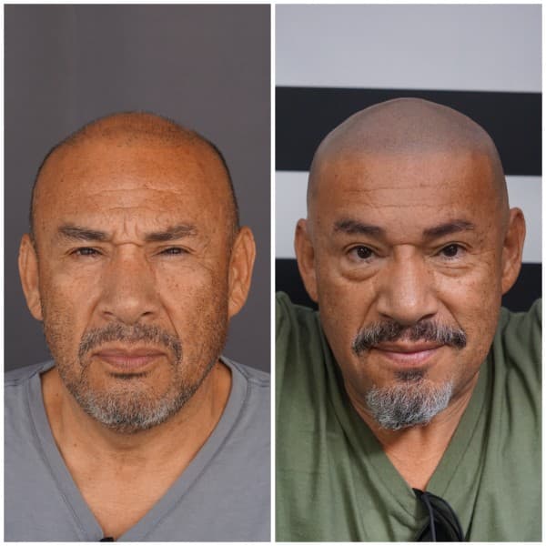 Full Scalp Coverage Before and After