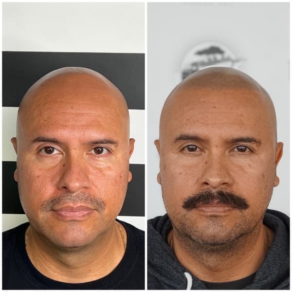 Hairline restoration SMP before and after result 2 at Union Barber SMP Torrance