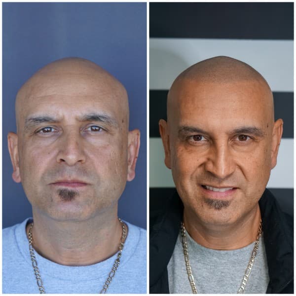 Scar Camouflage Before and After