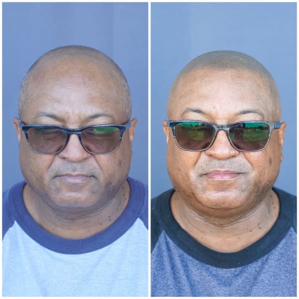 Full Scalp Coverage Before and After