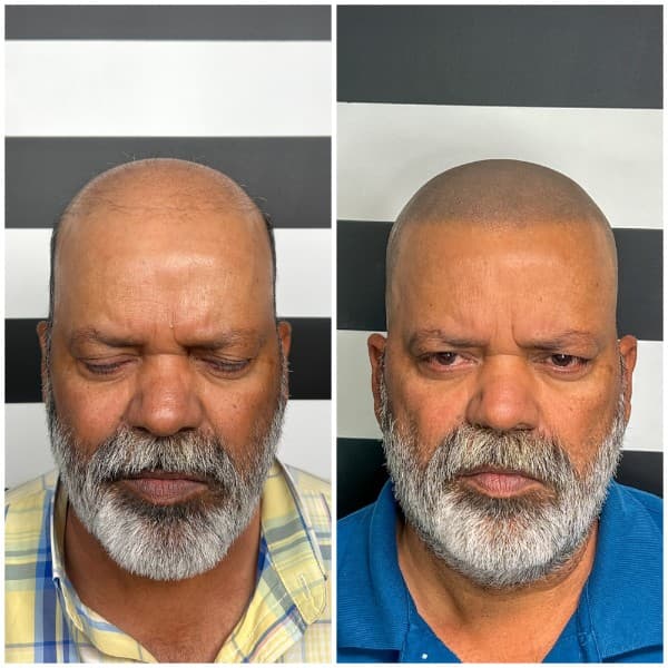 Hairline restoration SMP before and after result 3 at Union Barber SMP Torrance