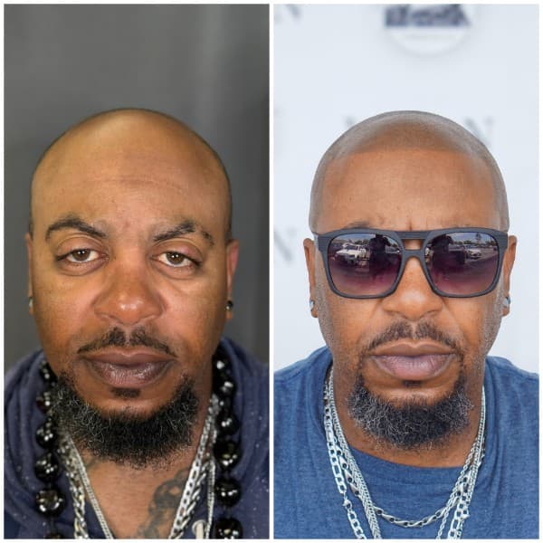 Alopecia Before and After