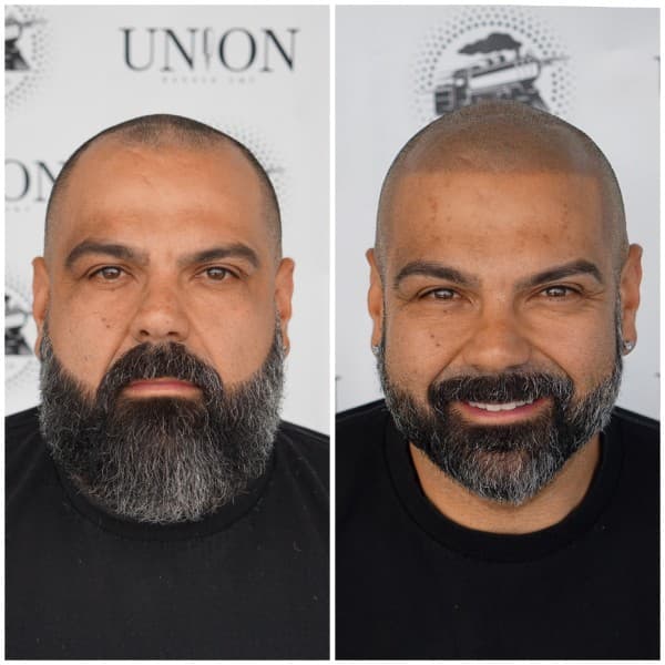 Hairline Restoration Before and After