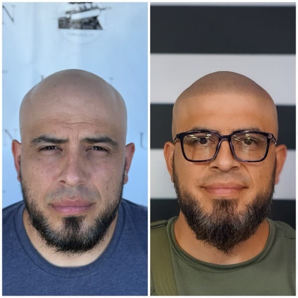 Full Scalp Coverage Before and After